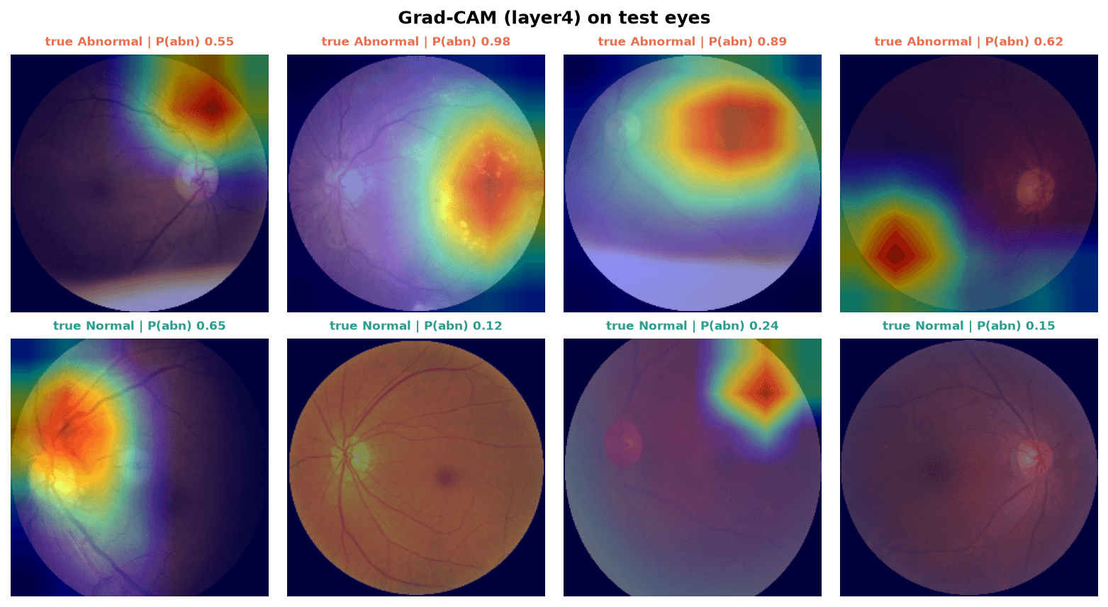 Grad-CAM heat-maps over eight test eyes, four abnormal and four normal