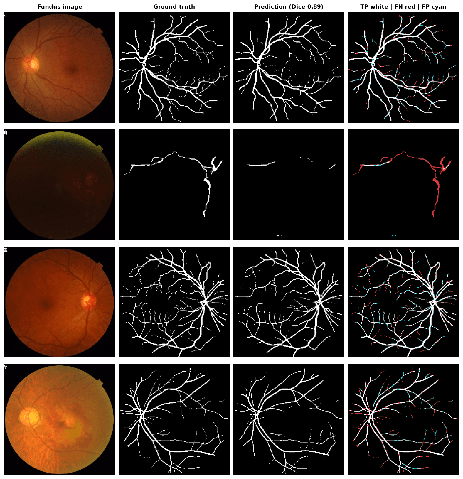 Four held-out fundus images with ground-truth vessel masks, U-Net predictions and an error overlay